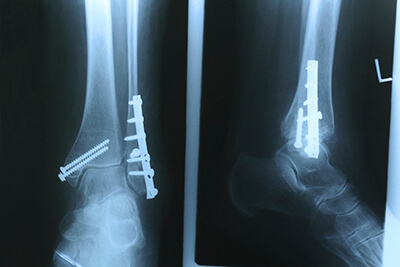 fracture repair